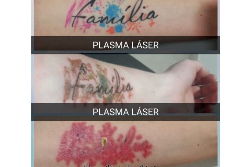 Borrar tatuajes antes y después - 643510