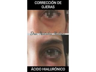 Corrección de ojeras