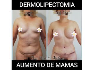 Dermolipectomía
