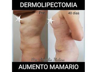 Dermolipectomía