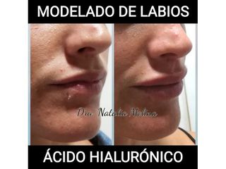 Aumento de labios con Ácido Hialurónico.