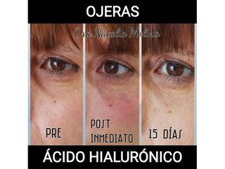 Eliminación de ojeras con ácido hialurónico