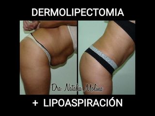 Dermolipectomía + Lipoaspiración