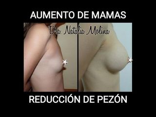 Aumento mamas