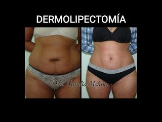 Dermolipectomía