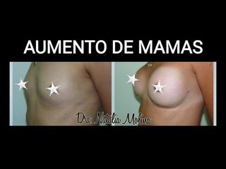 Aumento mamas