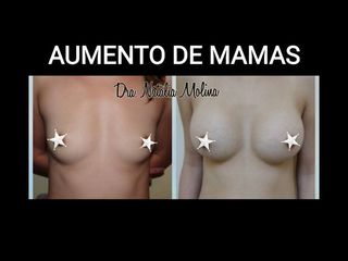 Aumento mamas