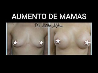 Aumento mamas