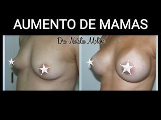 Aumento mamas
