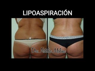 Lipoaspiración