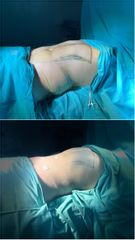 Abdominoplastia - Dr. Santiago Rosales Castiglione