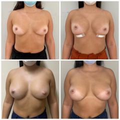 Aumento mamas - Dr. Santiago Rosales Castiglione