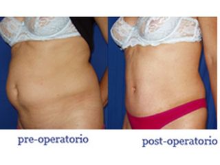 Dermolipectomía