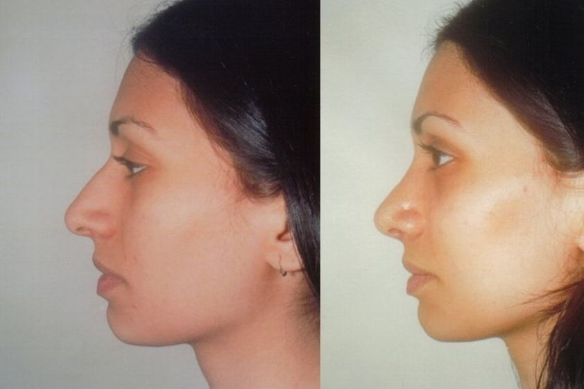 Rinoplastia antes y después - 282000