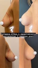 Levantamiento mamario con protesis - Dr. Mateo Castro Béduchaud
