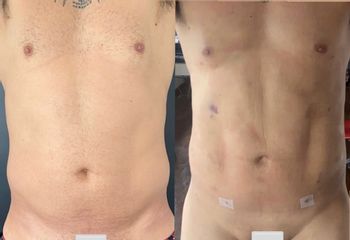 Liposucción - Dr. Mateo Castro Béduchaud