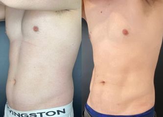 Liposucción - Dr. Mateo Castro Béduchaud