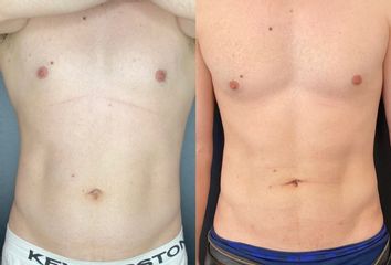Liposucción - Dr. Mateo Castro Béduchaud
