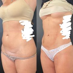 Abdominoplastia - Dr. Mateo Castro Béduchaud
