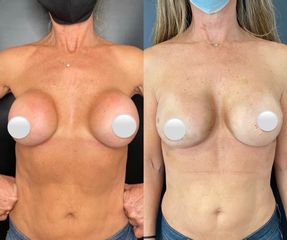 Mastopexia - Dr. Mateo Castro Béduchaud