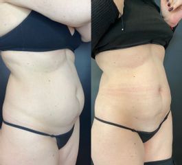 Abdominoplastia - Dr. Mateo Castro Béduchaud