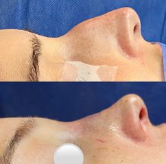 Rinoplastia - Dr. Mateo Castro Béduchaud