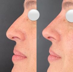 Rinoplastia - Dr. Mateo Castro Béduchaud