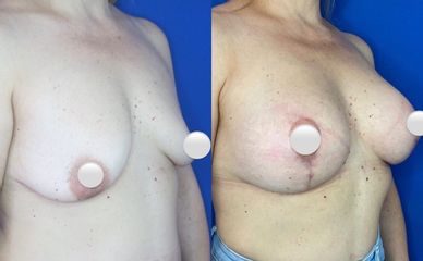 Mastopexia - Dr. Mateo Castro Béduchaud