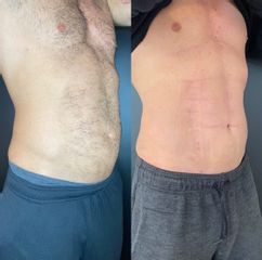 Liposucción - Dr. Mateo Castro Béduchaud