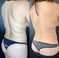 Liposucción - Dr. Mateo Castro Béduchaud