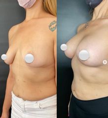 Aumento mamas - Dr. Mateo Castro Béduchaud