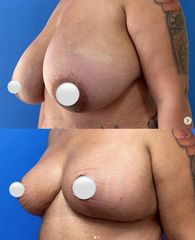 Mastopexia - Dr. Mateo Castro Béduchaud