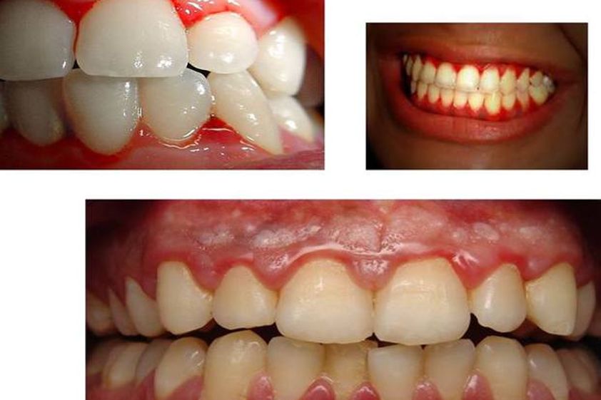 Periodoncia antes y después - 489656