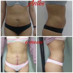 MELA (Miniextraccion Lipidica Ambulatoria)