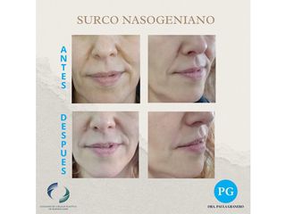 Relleno surco nasogeniano - Dra. Paula Granero