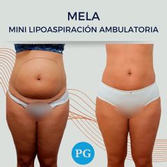 Liposucción - Dra. Paula Granero
