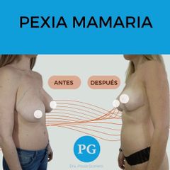 Mastopexia - Dra. Paula Granero