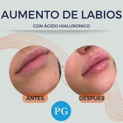 Relleno de labios - Dra. Paula Granero