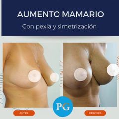 Aumento mamas - Dra. Paula Granero