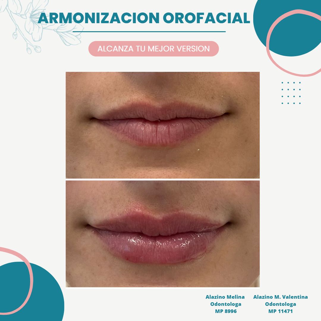 Rellenos Faciales Antes Y Después - Esteticas.com.ar - Esteticas.com.ar