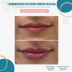 Rellenos faciales - Dra. María Valentina Alazino