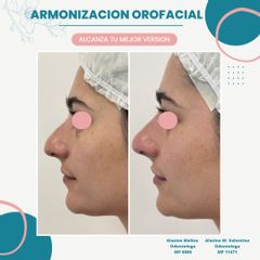 Rellenos faciales - Dra. María Valentina Alazino