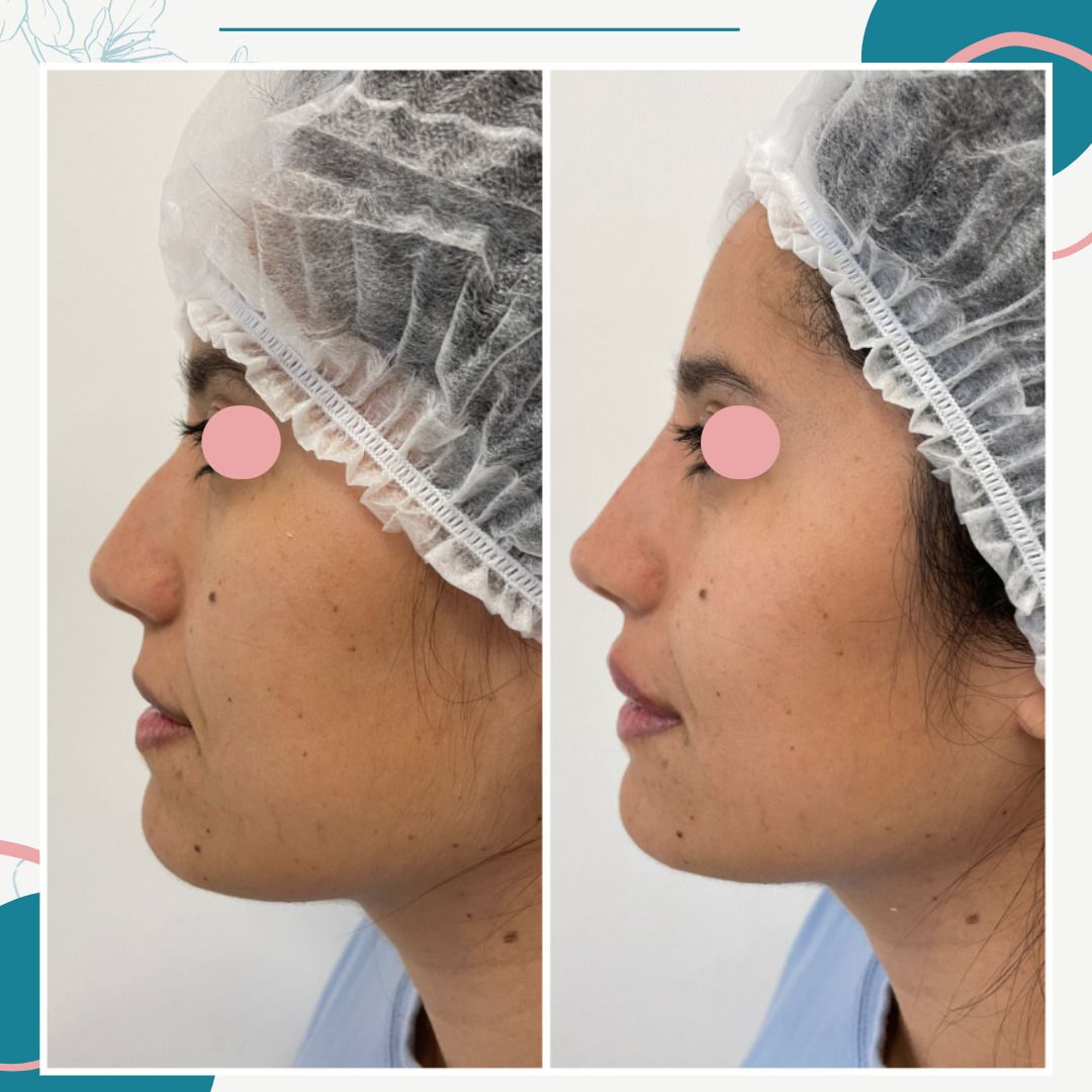 Rellenos Faciales Antes Y Después - Esteticas.com.ar - Esteticas.com.ar