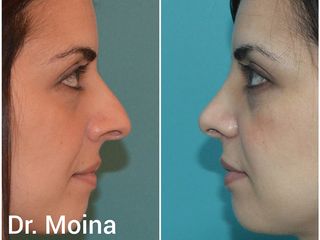 Dr. Moina - Rinoplastia 