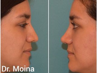 Dr. Moina - Rinoplastia 