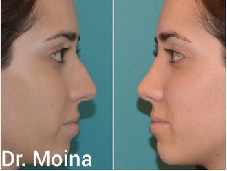 Rinoplastia antes y después - 641054
