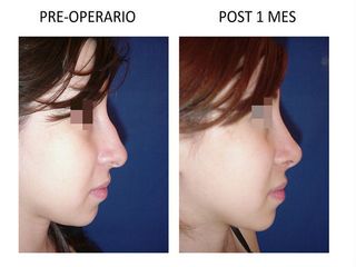 Rinoplastia