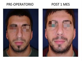 Rinoplastia y Mentón