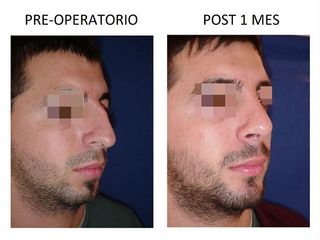 Rinoplastia Estética y Mentón