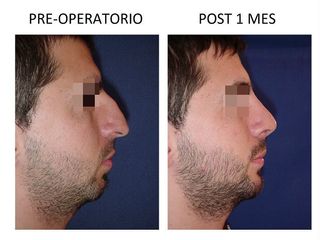 Rinoplastia y Mentón Implante